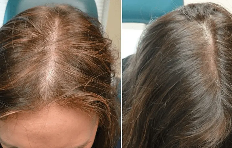 Folital Before and After